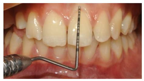 gingival thickness measurement|gingival biotype review.